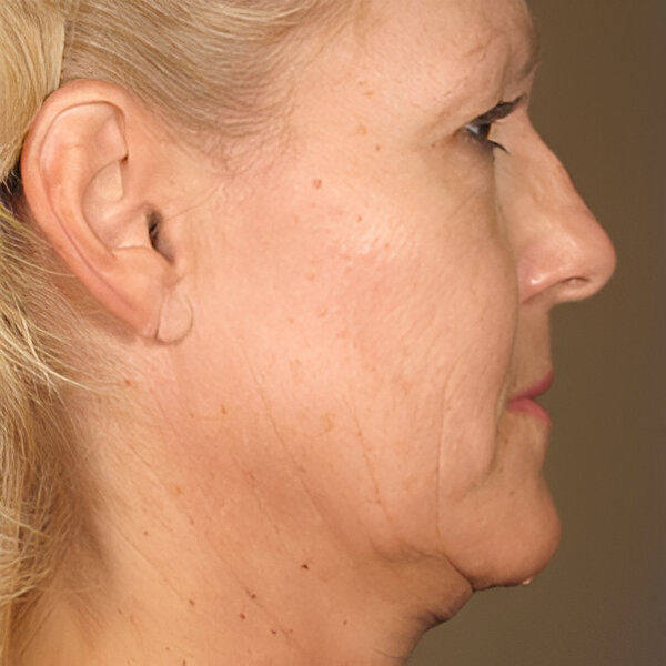 Lifting facial sin cirugía Barcelona antes y después