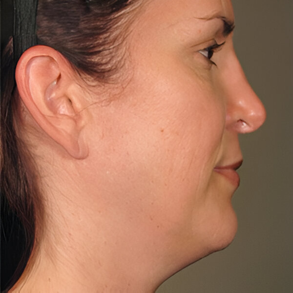 Ultherapy Prime Barcelona resultados